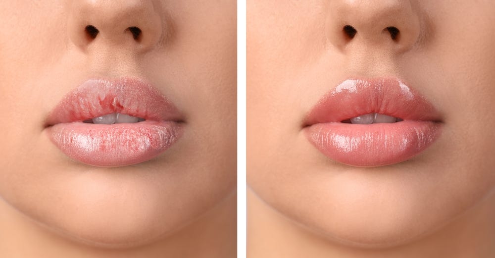 Lip Pigmentation Treatment in Ludhiana: Options, Costs, and FAQs