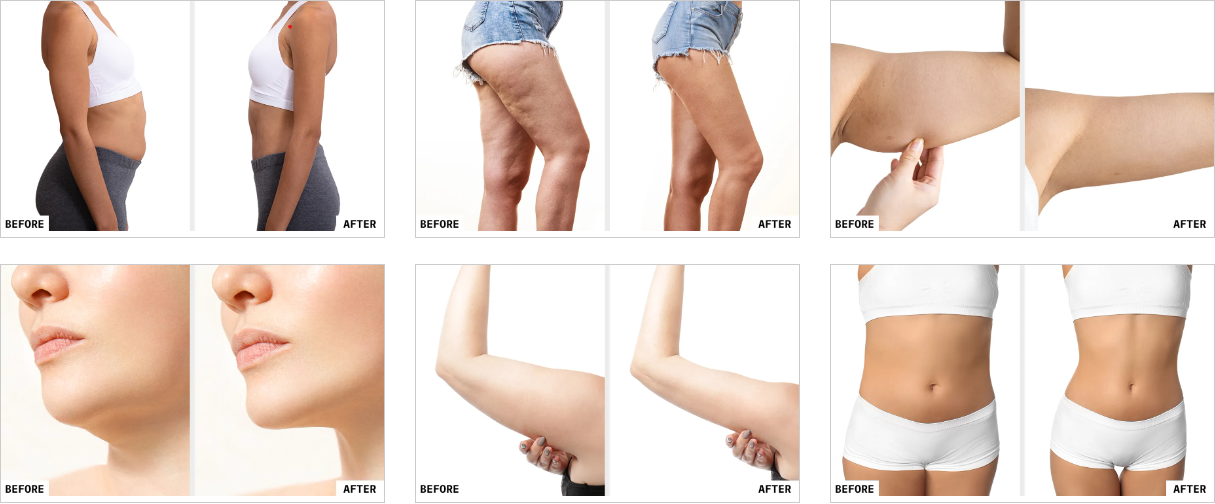 Does CoolSculpting Work? Proven Results & Facts | Kaya Clinic