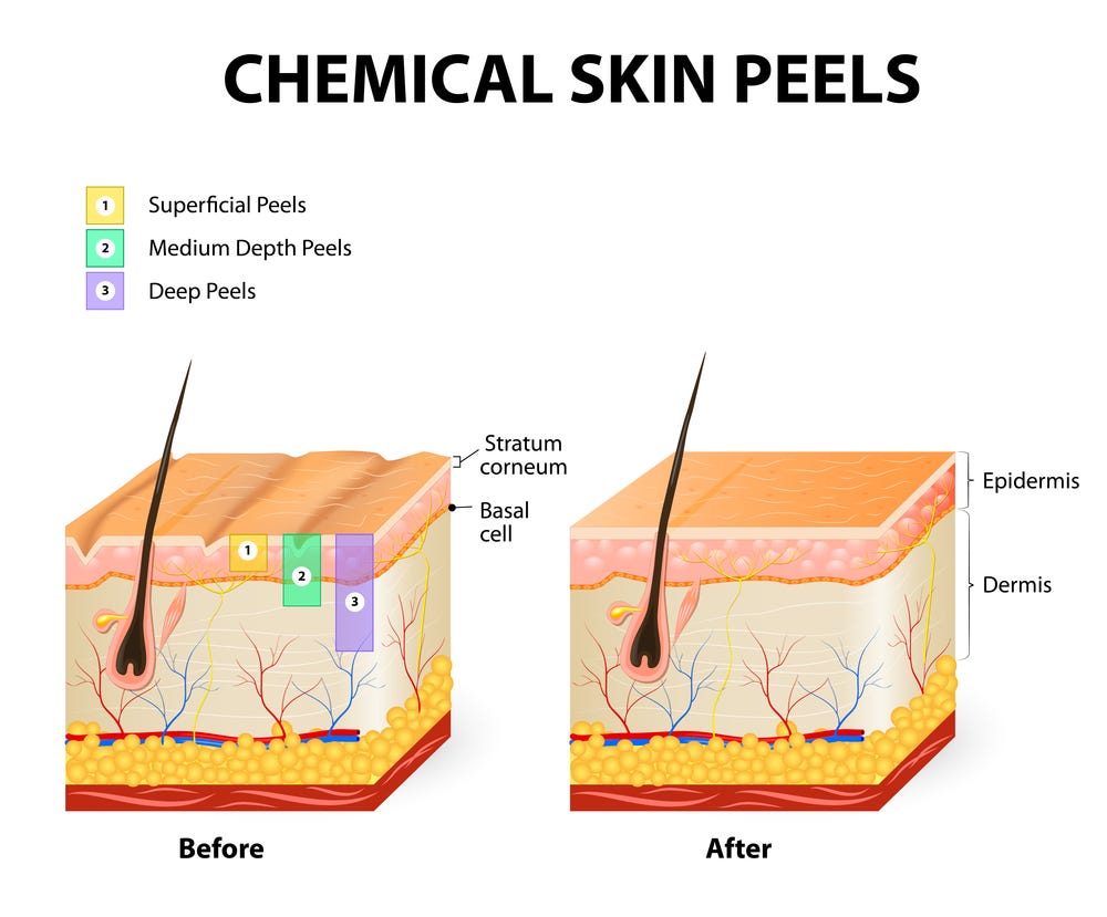 Different Types of Chemical Peel for Anti Aging