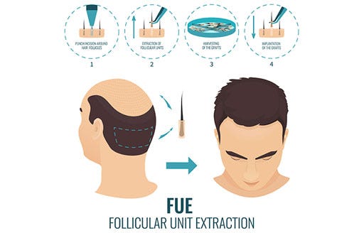 Hair Transplant surgery procedure in India