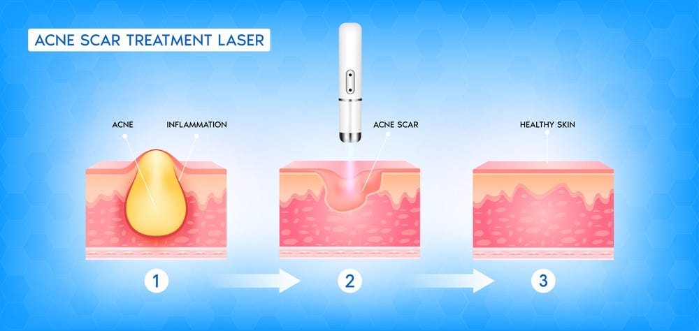 Pimple Scar Removal Treatments: Cost and Options in India