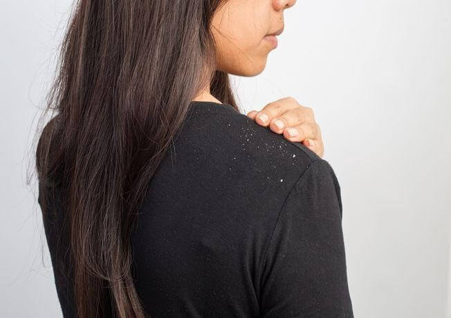 5 Dandruff Myths That You Should Stay Away From!