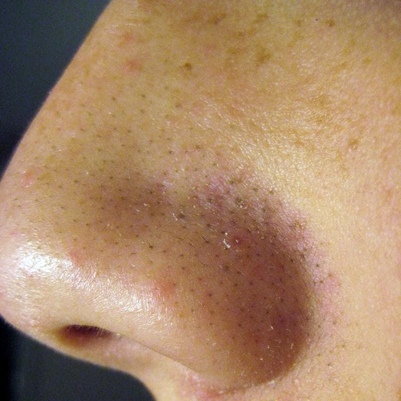 How Do You Get Rid of Melasma Permanently? 