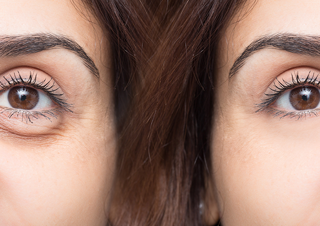 Getting Rid Of Puffy Eyes Is Easier That You Think