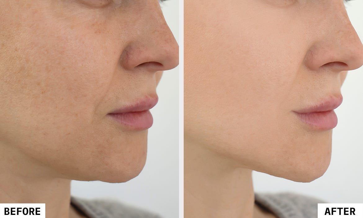 Before_After_01_HIFU_Anti_Ageing_1.jpg